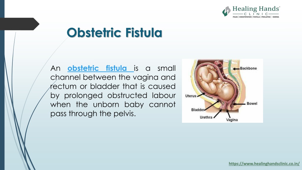 Ppt Obstetric Fistula Cure And Treatment At Healing Hands Clinic