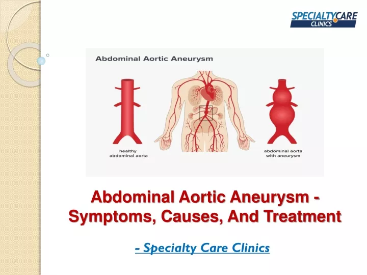 Ppt Abdominal Aortic Aneurysm Symptoms Causes And Treatment The Best