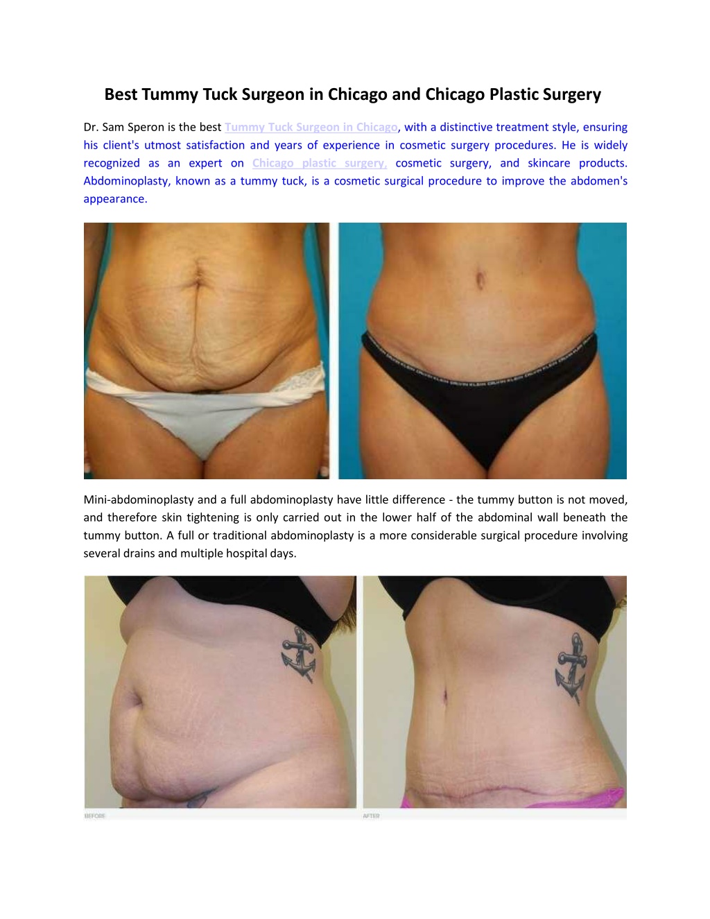 Ppt Best Tummy Tuck Surgeon In Chicago And Chicago Plastic Surgery Powerpoint Presentation