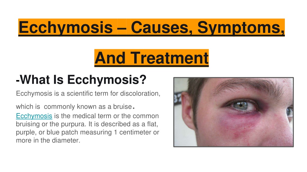 PPT - Ecchymosis – Causes, Symptoms, And Treatment PowerPoint ...