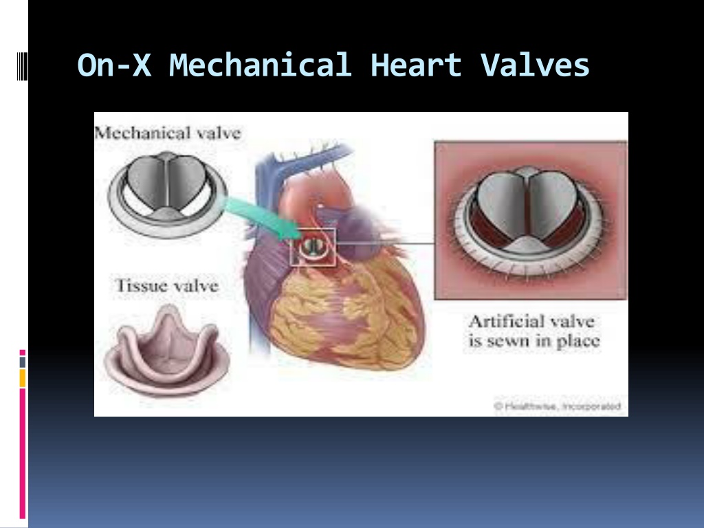 PPT OnX Mechanical Heart Valves PowerPoint Presentation, free