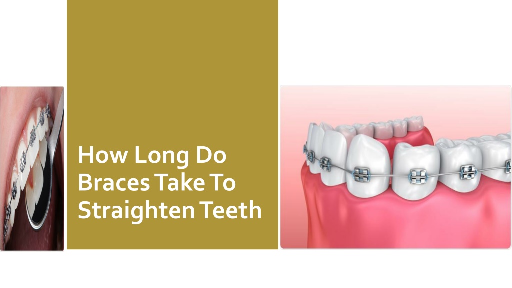 Ppt How Long Do Braces Take To Straighten Teeth Powerpoint Presentation Id 10589114