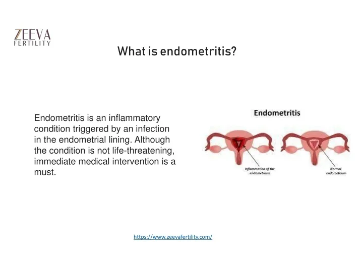 PPT Fertility Expert in Noida explains What is endometritis