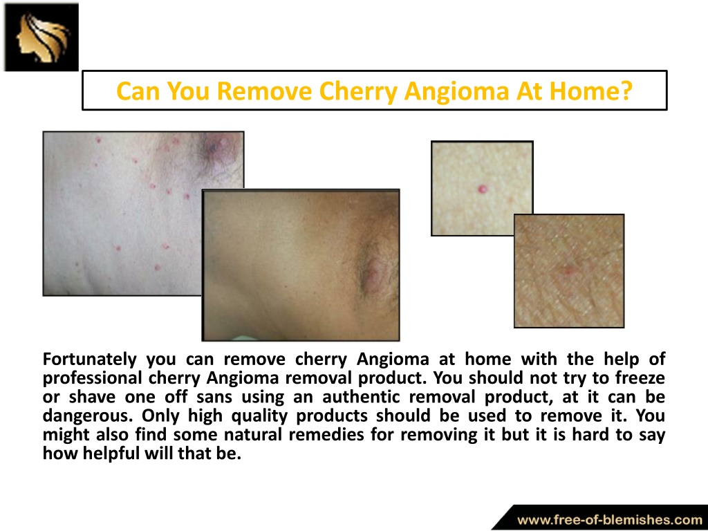 Ppt What Is Cherry Angioma And How To Remove Cherry Angioma At Home