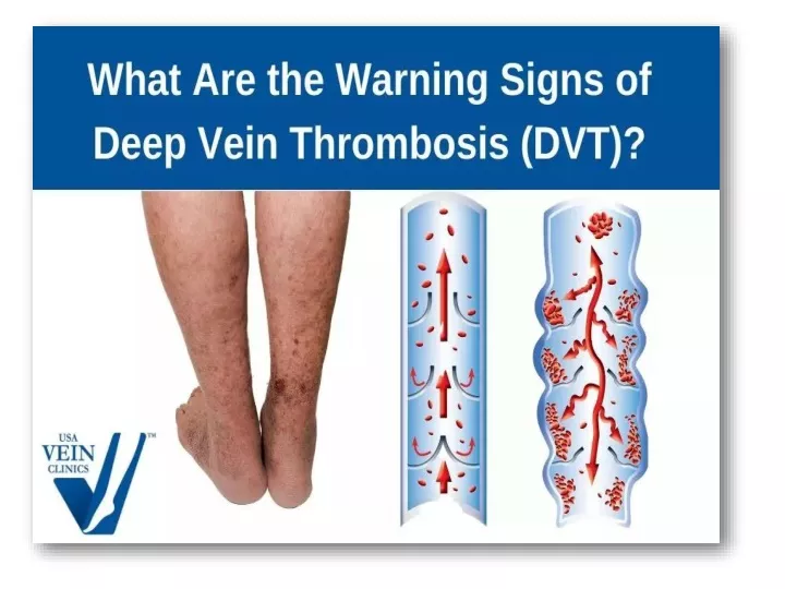 PPT - What Are The Most Common Signs Of DVT PowerPoint Presentation ...