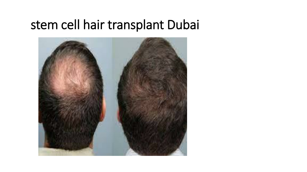 approach to alopecia ppt