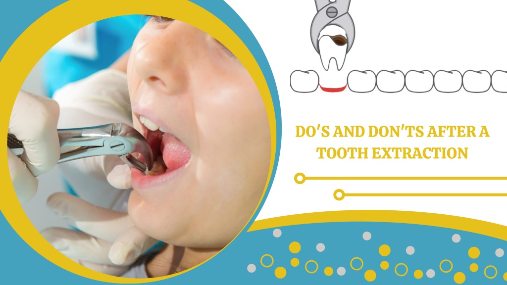 PPT Do's and Don'ts After a Tooth Extraction PowerPoint