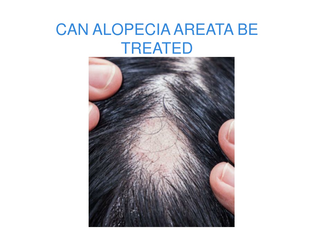 PPT - CAN ALOPECIA AREATA BE TREATED PowerPoint Presentation, Free ...