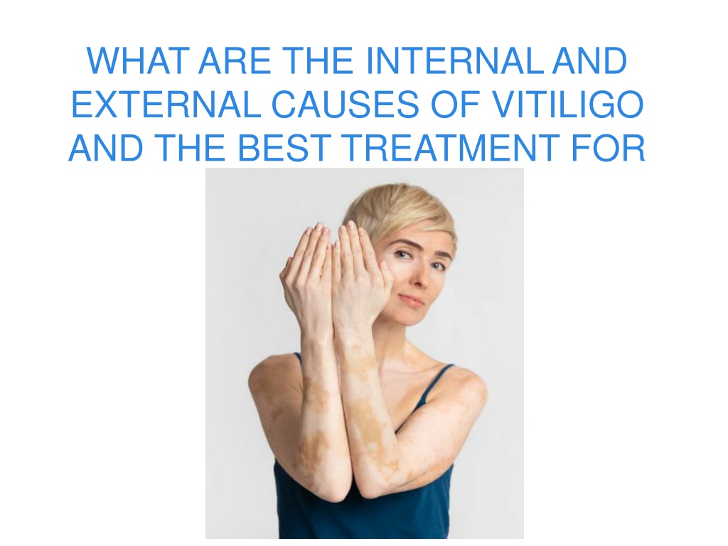 PPT - WHAT ARE THE INTERNAL AND EXTERNAL CAUSES OF VITILIGO AND THE ...