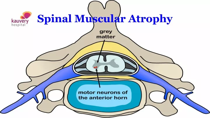 Ppt Spinal Muscular Atrophy Powerpoint Presentation Free Download