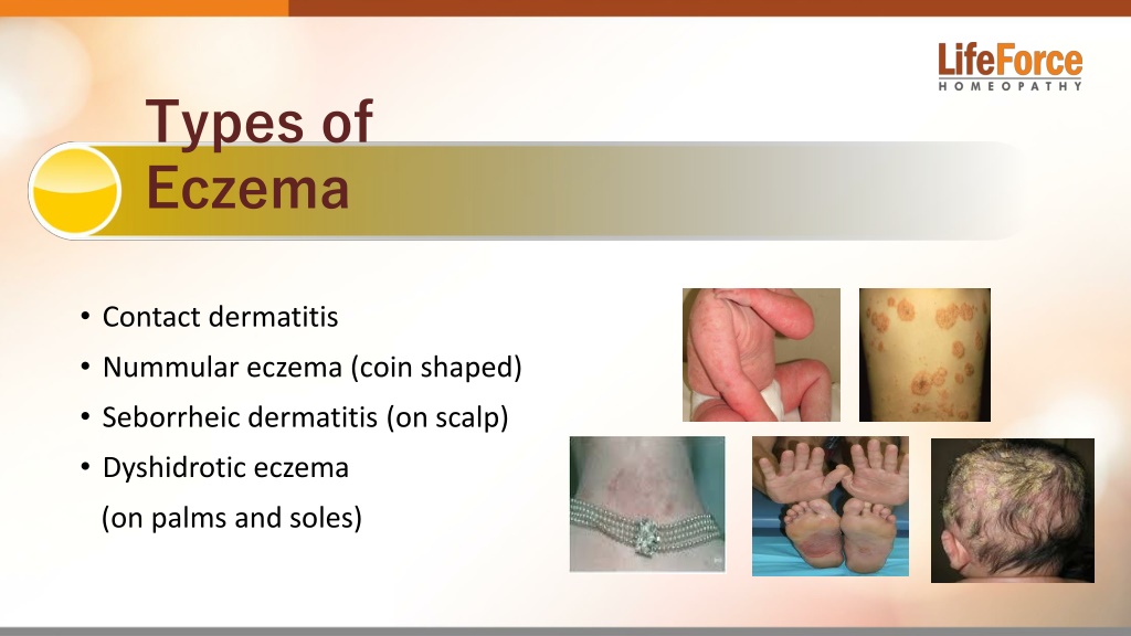 PPT - Know Everything About Atopic Dermatitis Eczema PowerPoint ...