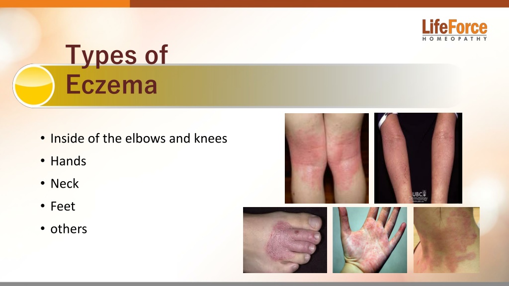 PPT - Know Everything About Atopic Dermatitis Eczema PowerPoint ...