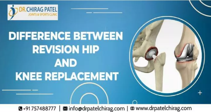 Ppt Difference Between Revision Hip And Knee Replacement Dr Chirag Patel Powerpoint