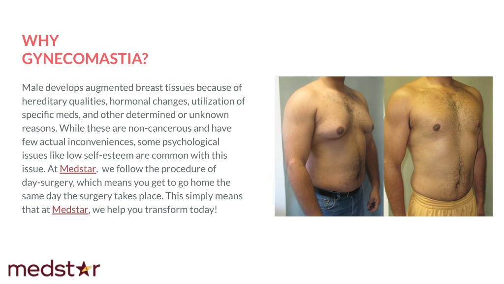 Ppt Best Gynecomastia Surgery In Dubai Powerpoint Presentation Free