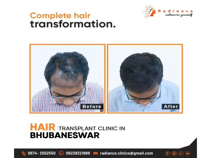 PPT - Hair Transplant in Odisha PowerPoint Presentation, free download -  ID:10801900