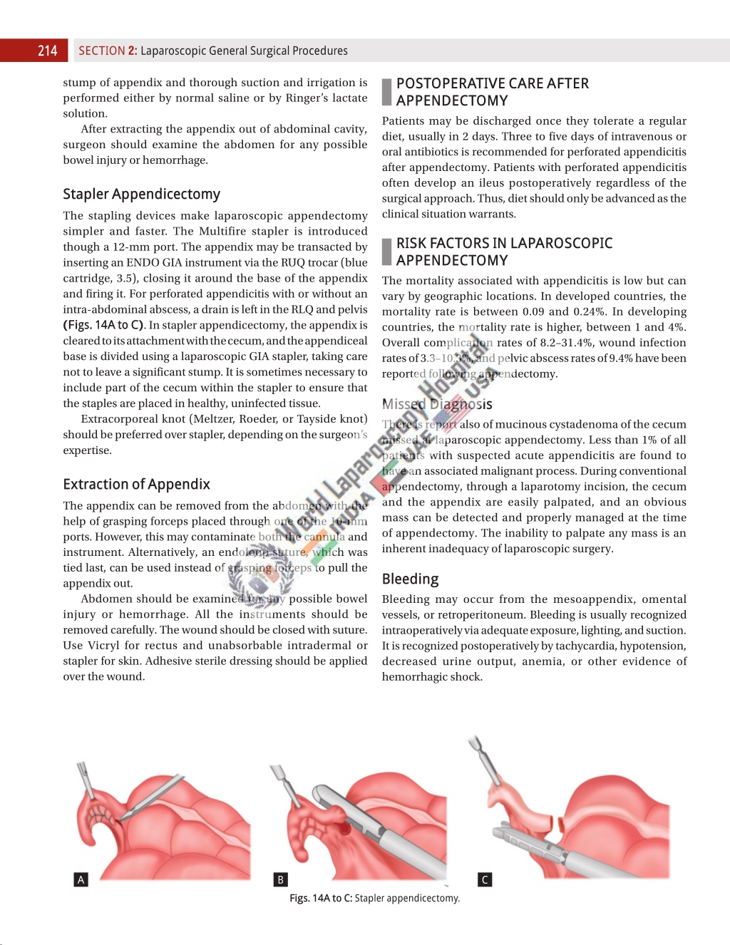 Ppt Laparoscopic Appendicectomy Powerpoint Presentation Free