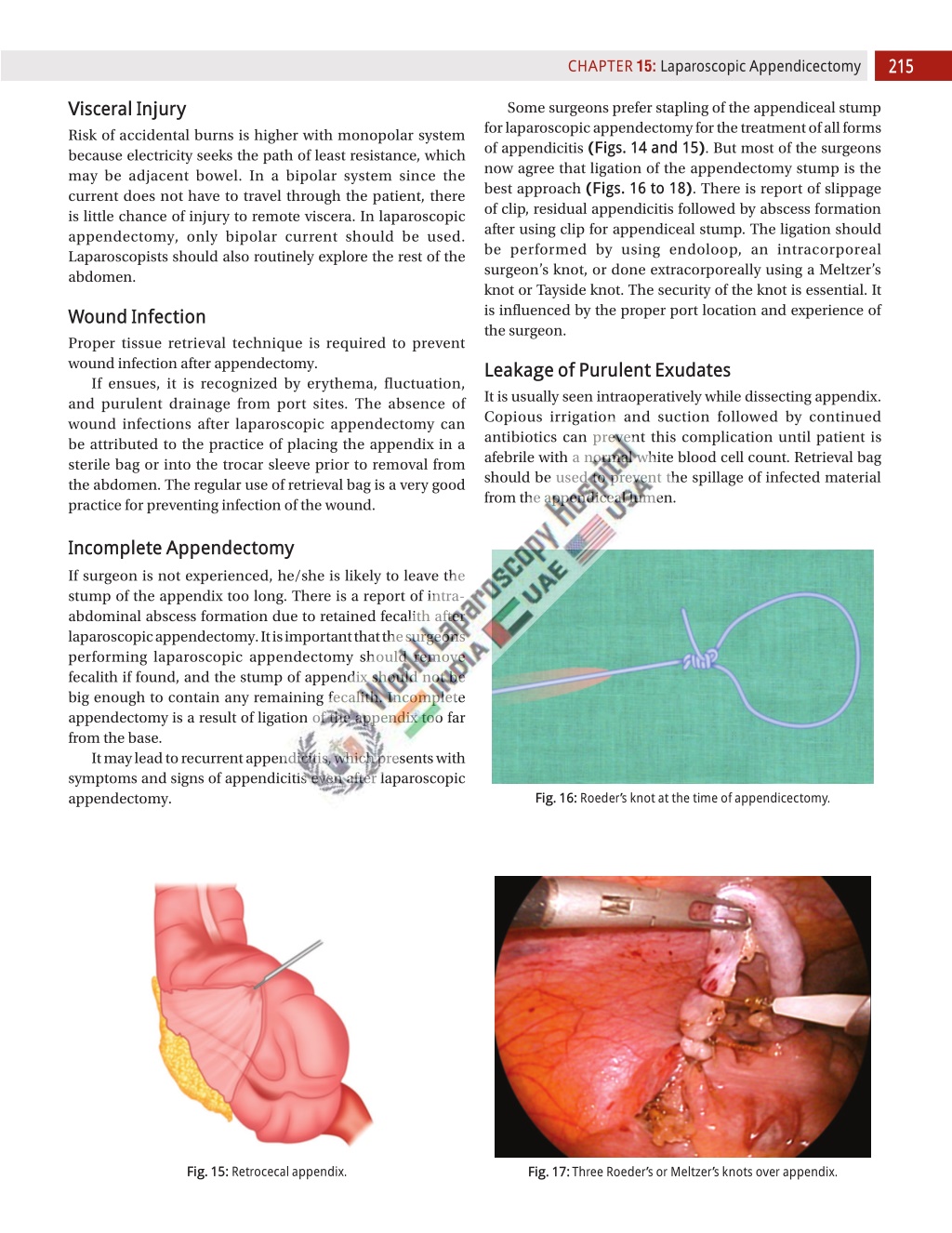 Ppt Laparoscopic Appendicectomy Powerpoint Presentation Free