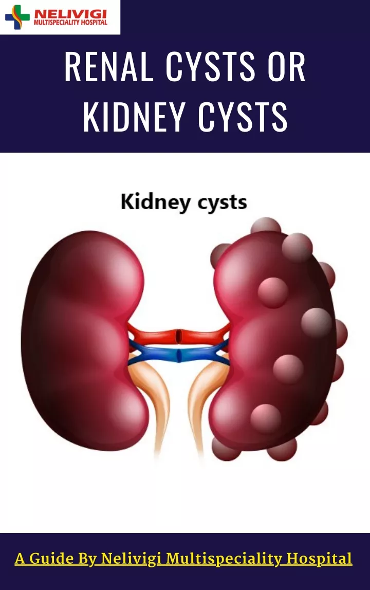 PPT - Renal Cysts Or Kidney Cysts - Urology Hospitals - Nelivigi ...