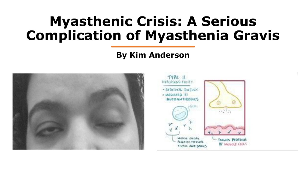 Ppt Myasthenia Gravis Powerpoint Presentation Free Download Id