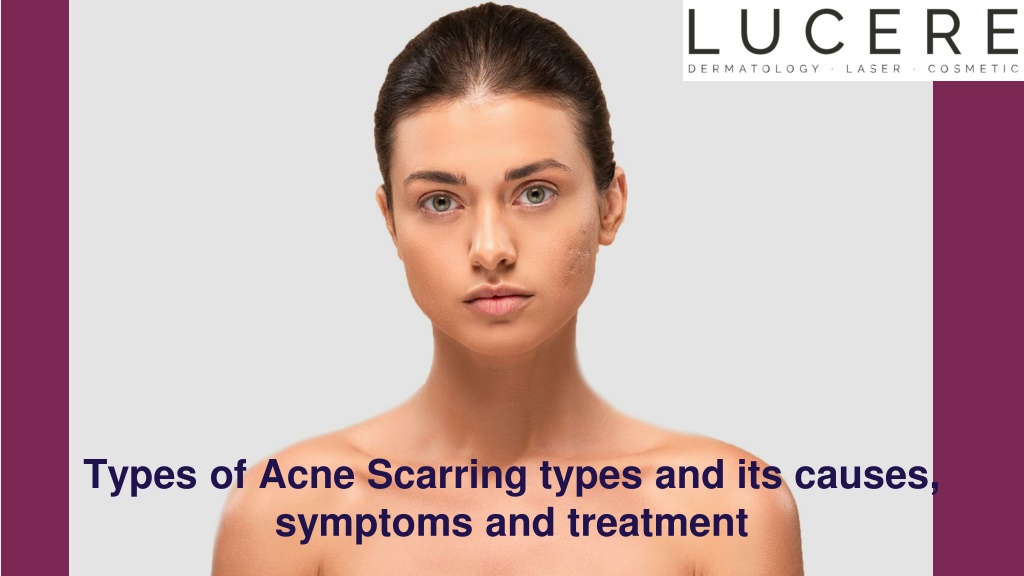 PPT - Types of Acne Scarring types and its causes, symptoms and ...