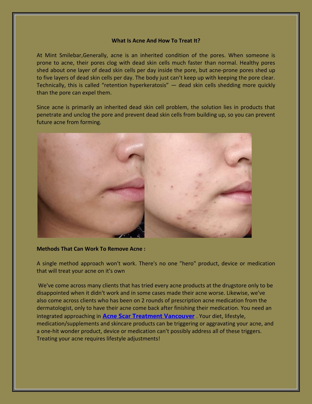 Ppt What Is Acne And How To Treat It Powerpoint Presentation Free Download Id10941214