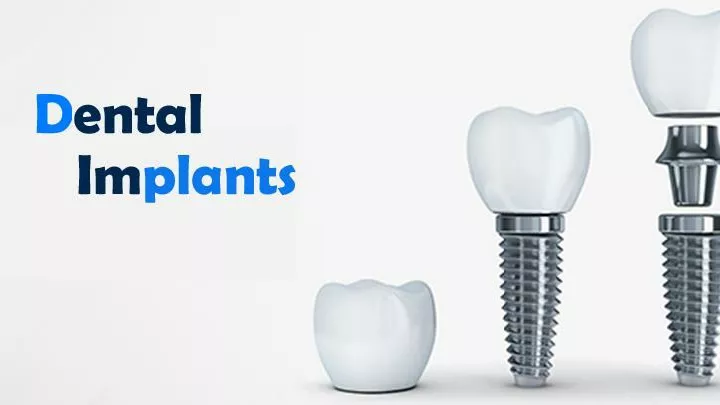 PPT - Dental Implants PowerPoint Presentation, Free Download - ID:10958806