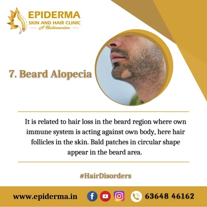 PPT Beard Alopecia Best Hair loss treatment in Bangalore Epiderma