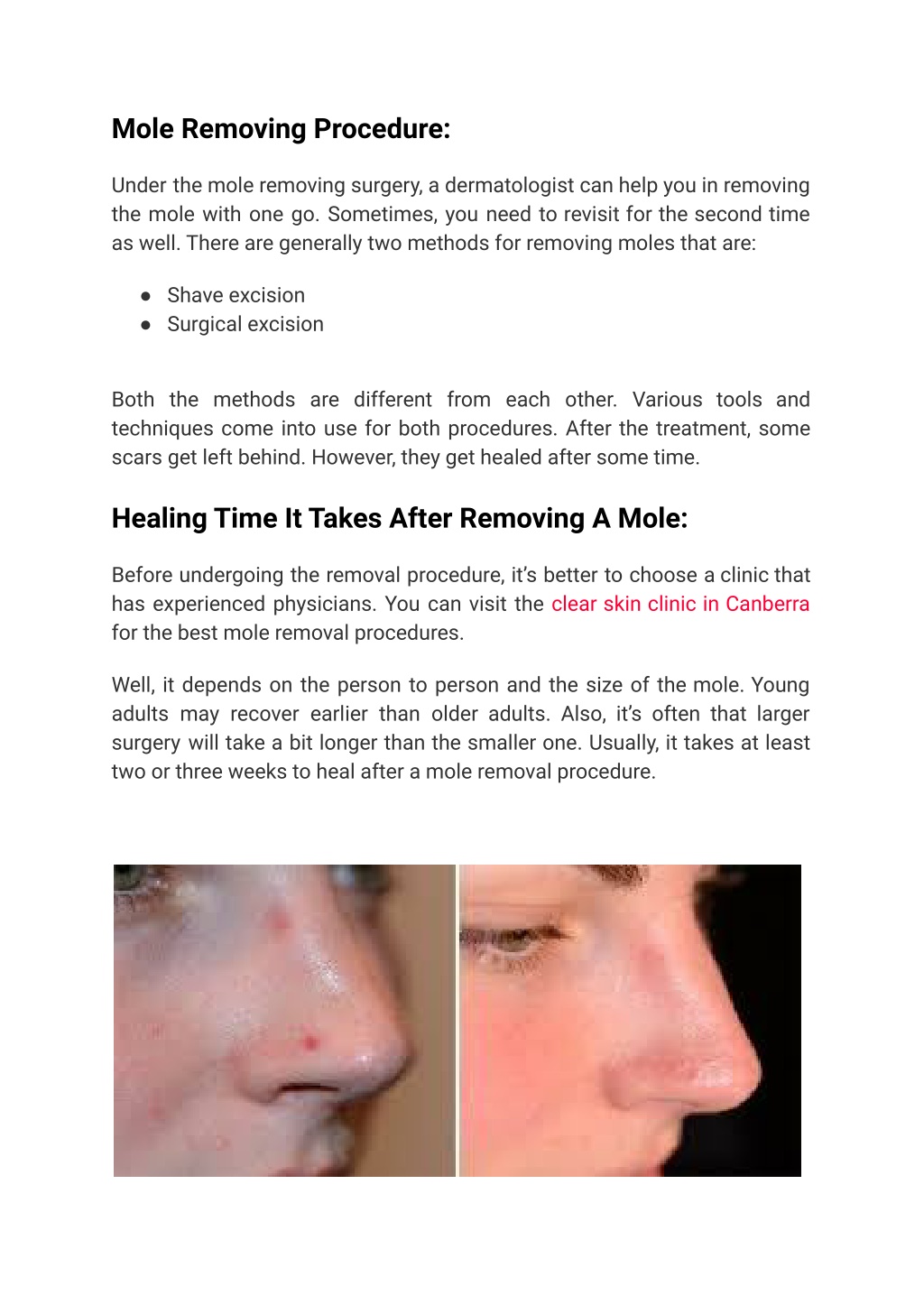 PPT - Healing Time It Takes After Removing Mole And Aftercare Tips ...