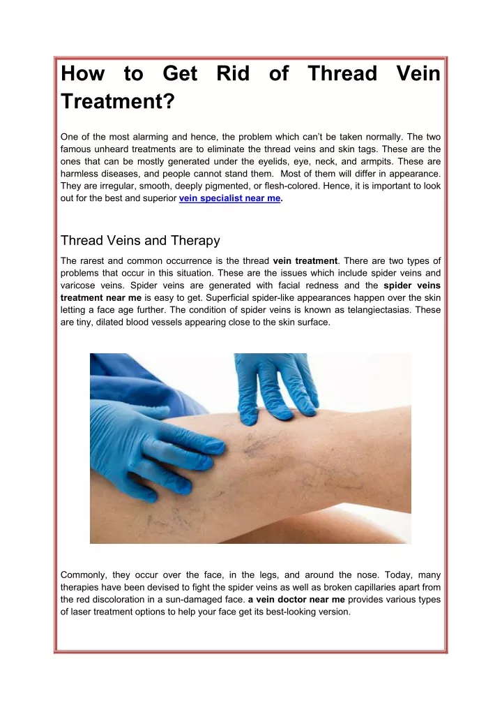 ppt-how-to-get-rid-of-thread-vein-treatment-powerpoint-presentation