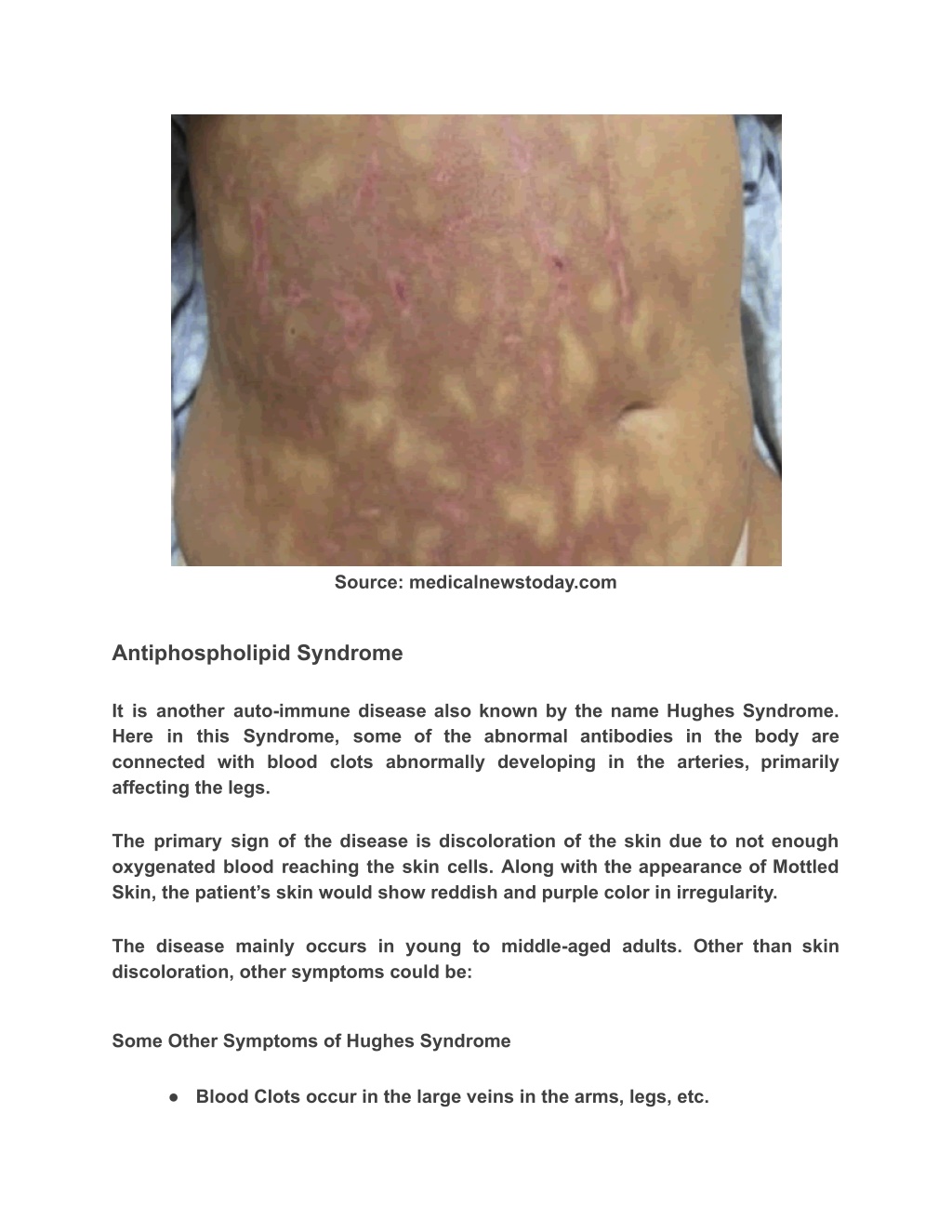 Ppt Mottled Skin Treatment Causes Symptoms And More Powerpoint Presentation Id 10981693