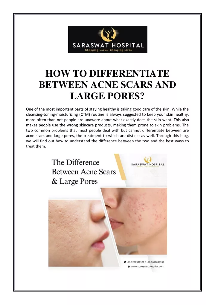 Ppt How To Differentiate Between Acne Scars And Large Pores Powerpoint Presentation Id 10998826