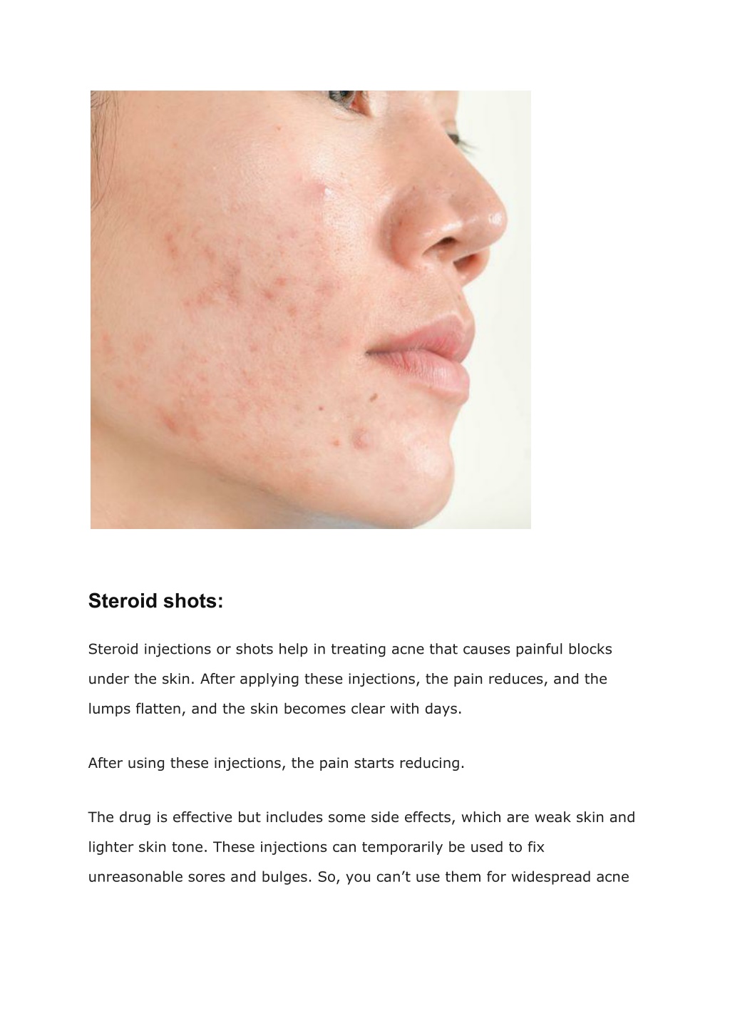 PPT - How Skin Care Treatment Can Help You Get Rid of Acne PowerPoint ...