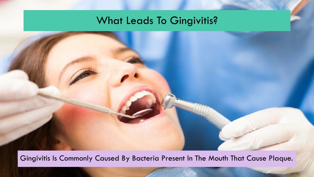 PPT - What Is Gingivitis And How To Avoid It? PowerPoint Presentation ...