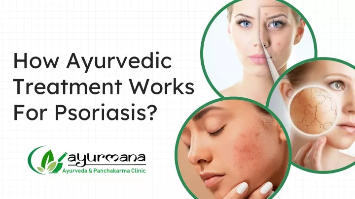 PPT - How Ayurvedic Treatment Works For Psoriasis? PowerPoint ...