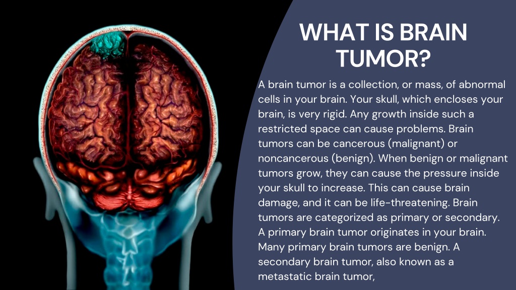 PPT - Best Brain Tumor PowerPoint Presentation, free download - ID:11063683