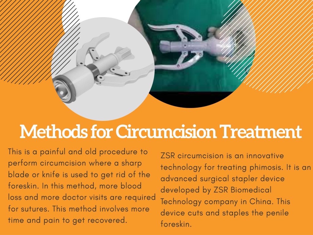 Ppt Quick Facts You Need To Know About Laser Circumcision Surgery