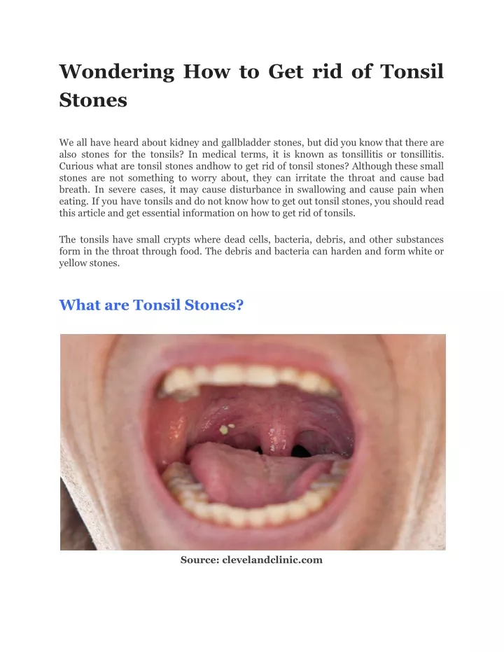 PPT - Wondering How to Get rid of Tonsil Stones PowerPoint Presentation ...