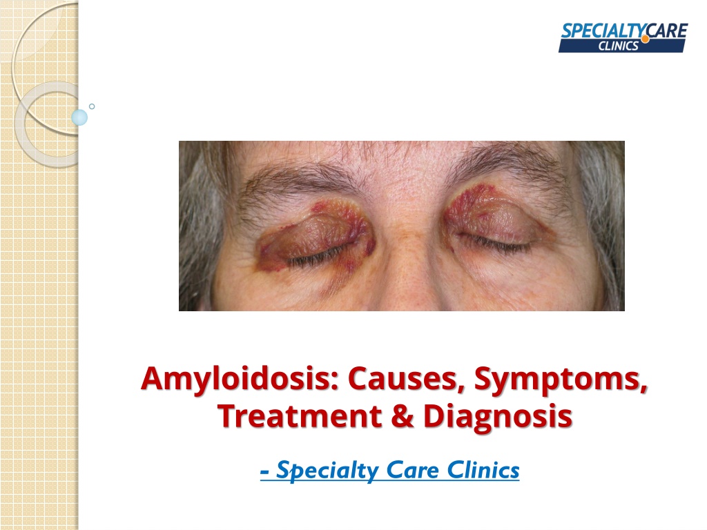 Ppt Amyloidosis Causes Symptoms Treatment And Diagnosis Powerpoint Presentation Id11114561 9855