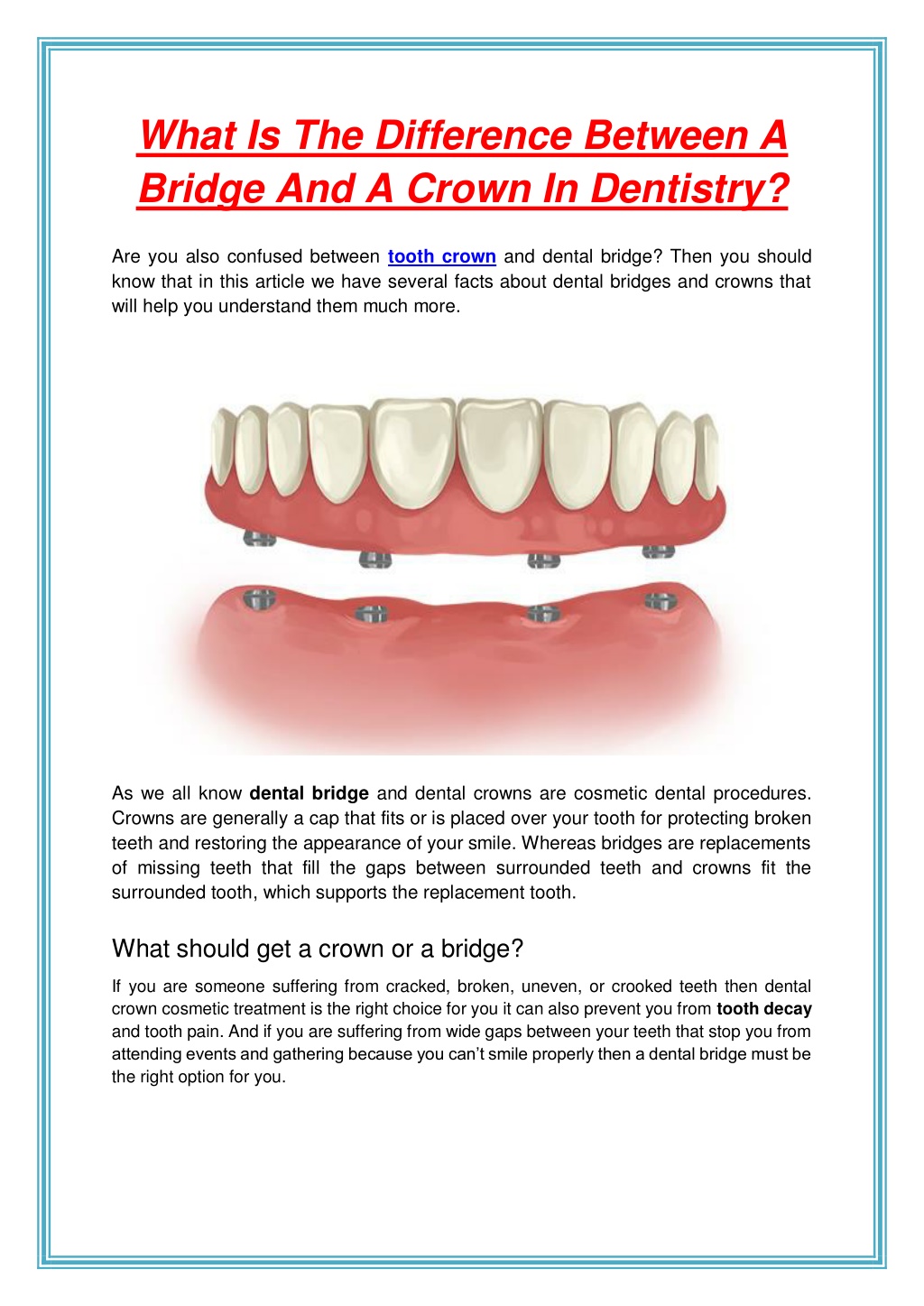 ppt-what-is-the-difference-between-a-bridge-and-a-crown-in-dentistry