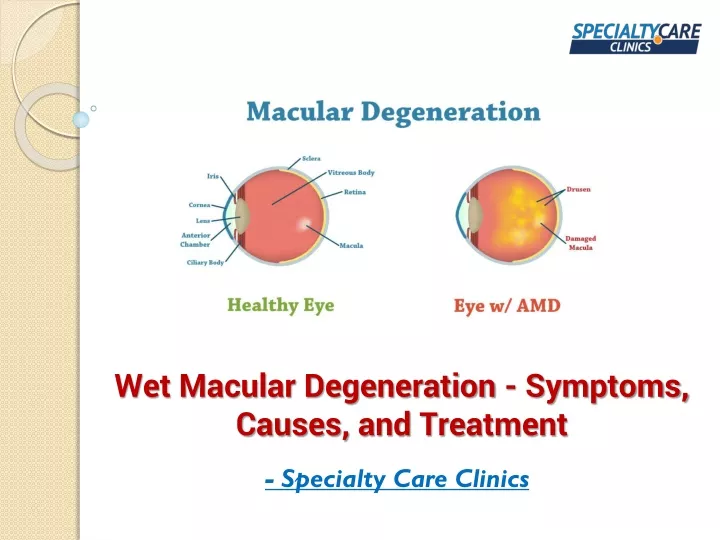 PPT - Wet Macular Degeneration - Symptoms, Causes, And Treatment ...