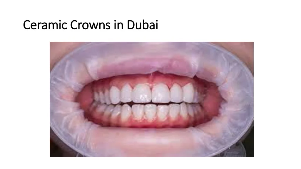 PPT Ceramic Crowns in Dubai PowerPoint Presentation, free download