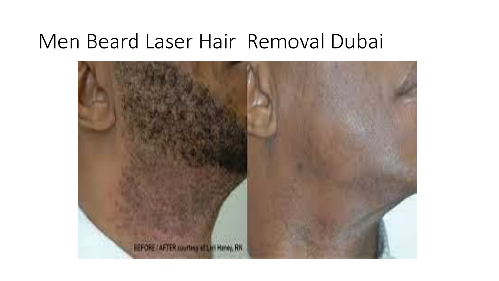 PPT Men Beard Laser Hair Removal Dubai PowerPoint Presentation, free download ID11166309