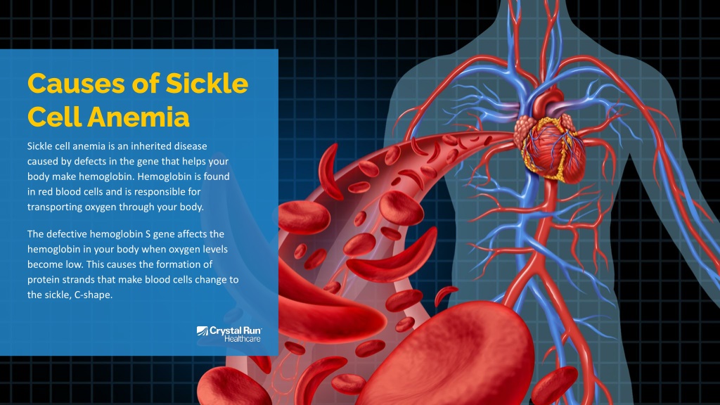 PPT - What’s Sickle Cell Anemia? PowerPoint Presentation, free download ...