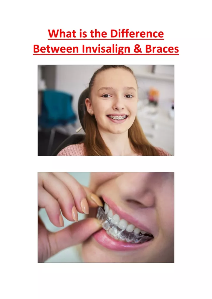 PPT What Is The Difference Between Invisalign Braces PowerPoint Presentation ID