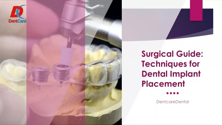 PPT - Surgical Guide Techniques For Dental Implant Placement PowerPoint ...