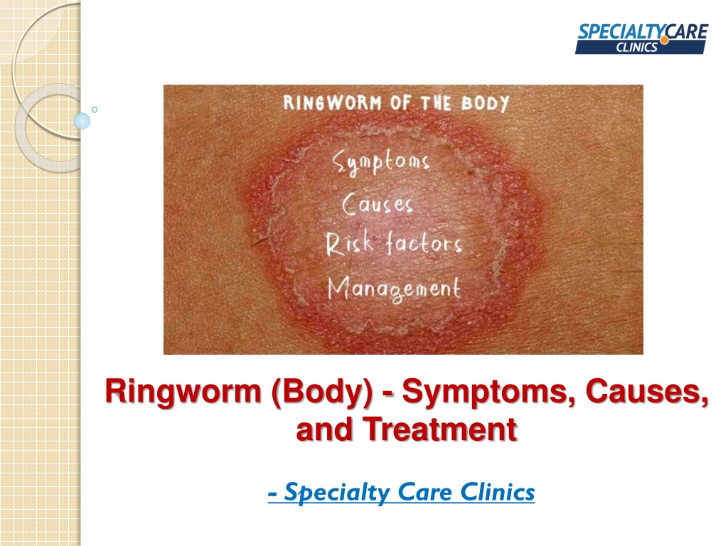 PPT - Ringworm (Body) - Symptoms, Causes, and Treatment PowerPoint ...