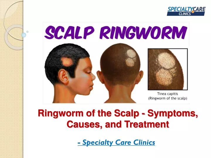 PPT - Ringworm of the Scalp - Symptoms, Causes, and Treatment ...