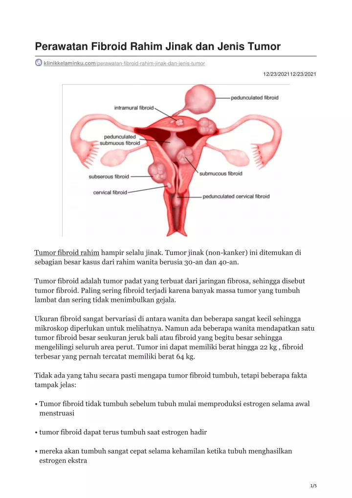 Ppt Perawatan Fibroid Rahim Jinak Dan Jenis Tumor Klinikkelaminku