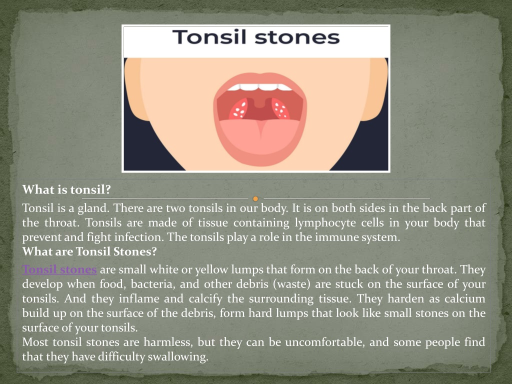 Ppt Tonsil Stones And Treatment Ent Treatment In Gurgaon Powerpoint