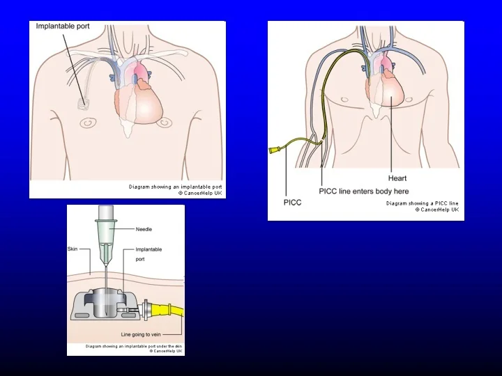 PPT HICKMAN CATHETER PowerPoint Presentation, free download ID9277930